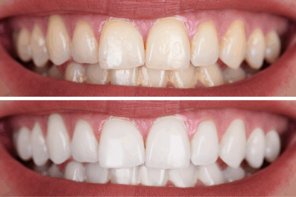 CENTRO DENTAL ROBERTO CRISTÓBAL blanqueamiento dental
